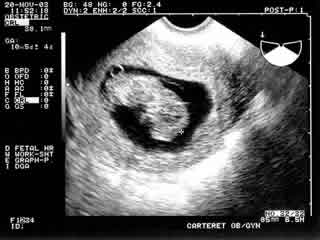 Sonogram at 10 weeks